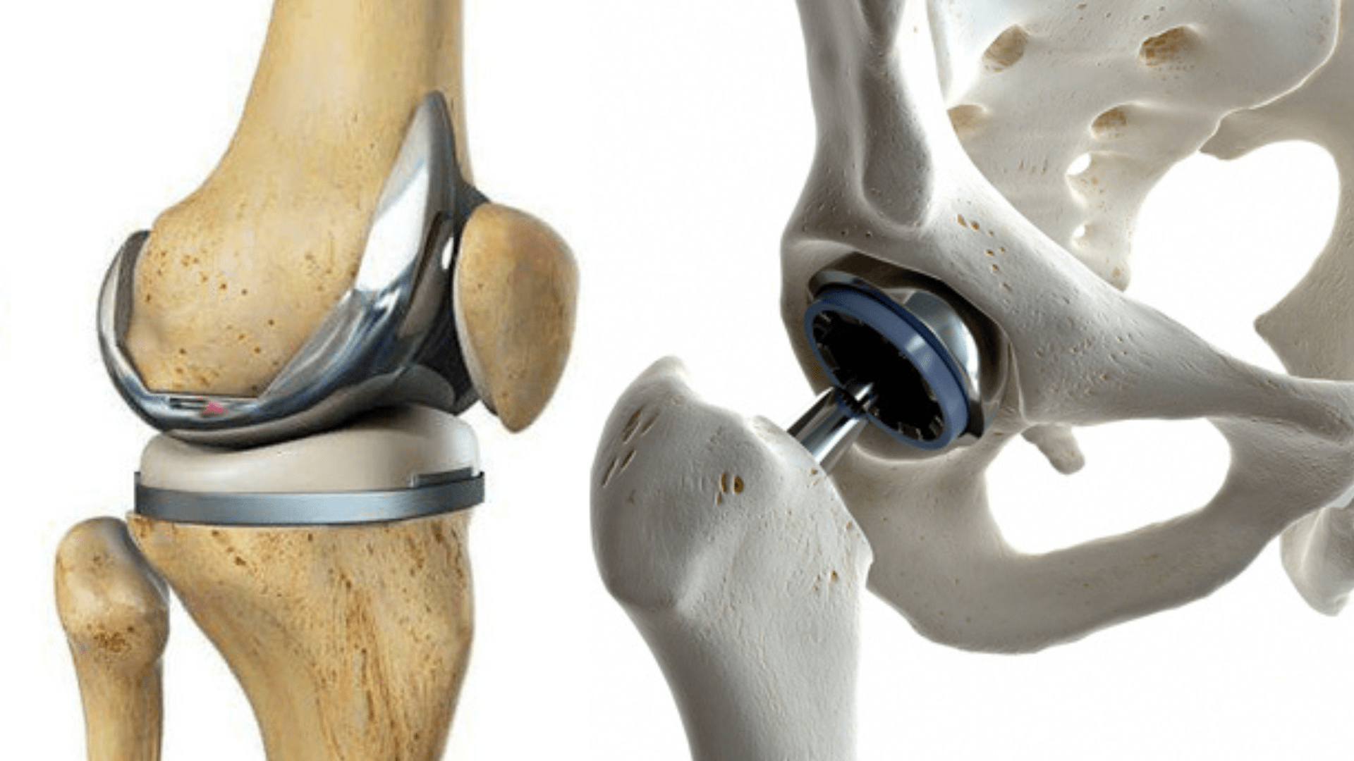 Joint Replacements - Knee & Hip